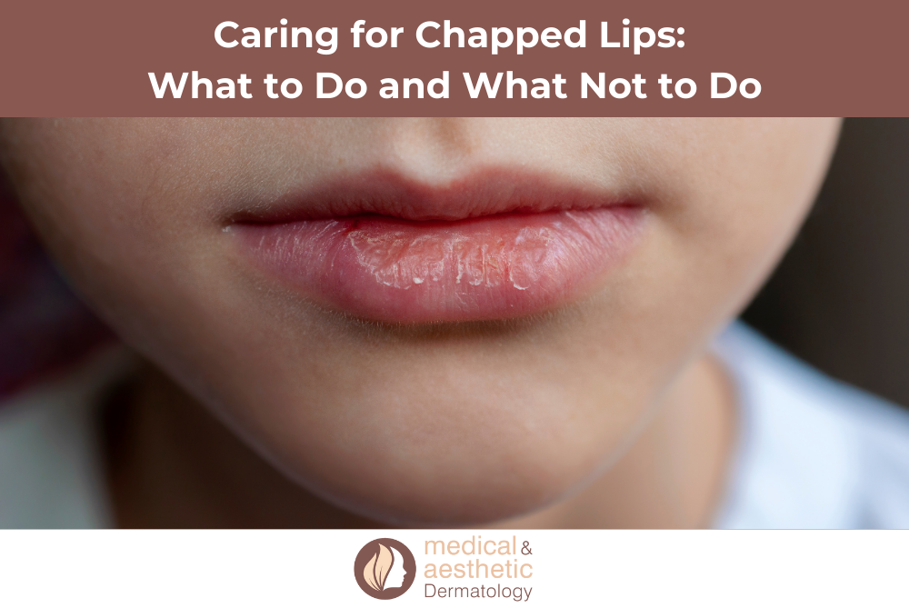 Caring for Chapped Lips What to Do and What Not to Do